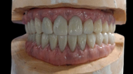 implant-vinayaga dental lab